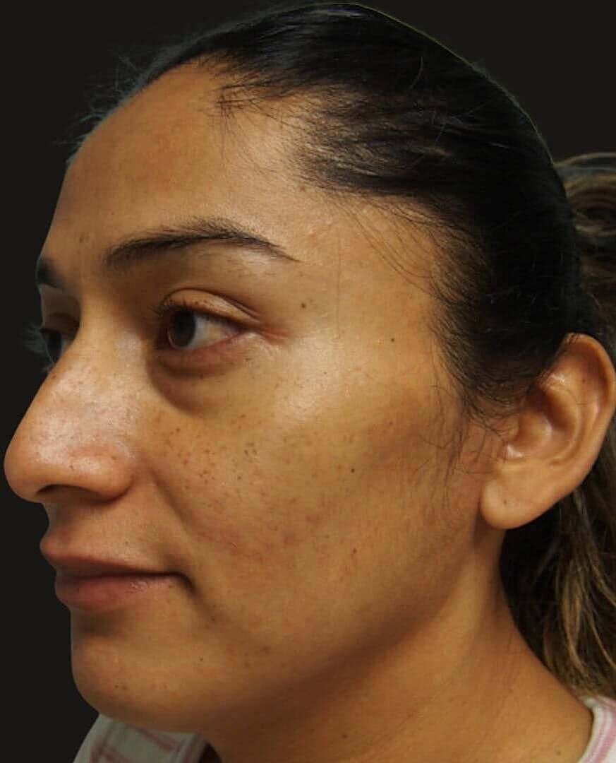 Rhinoplasty Before & After