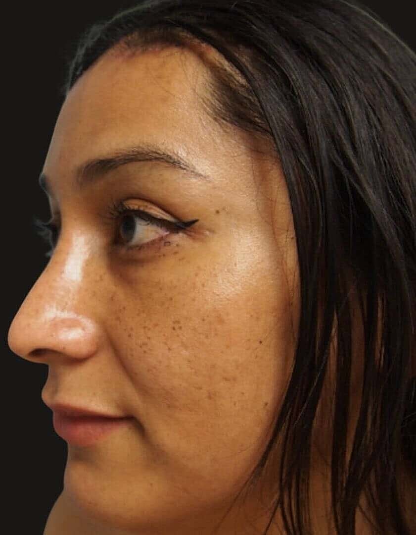 Rhinoplasty Before & After