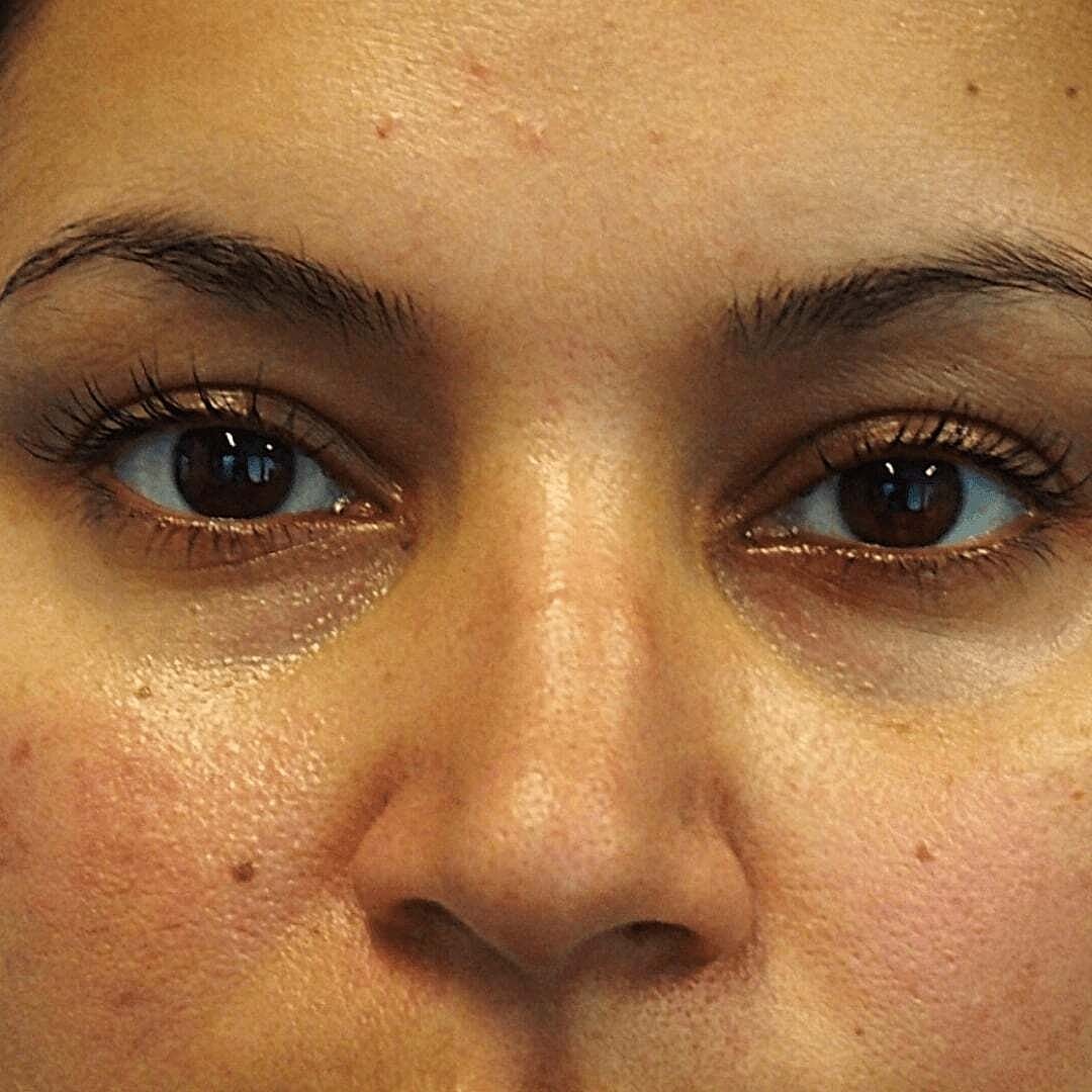 Rhinoplasty Before & After