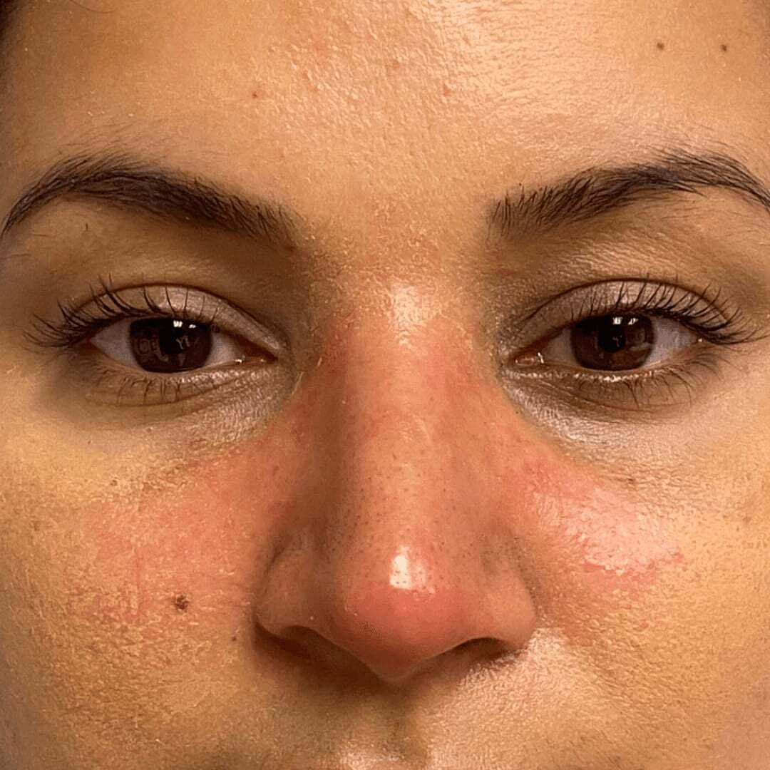 Rhinoplasty Before & After