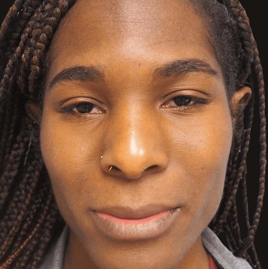 Rhinoplasty Before & After
