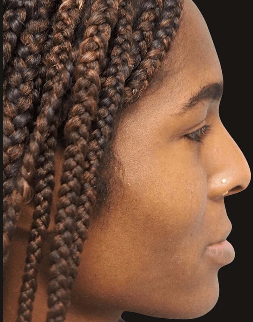 Rhinoplasty Before & After