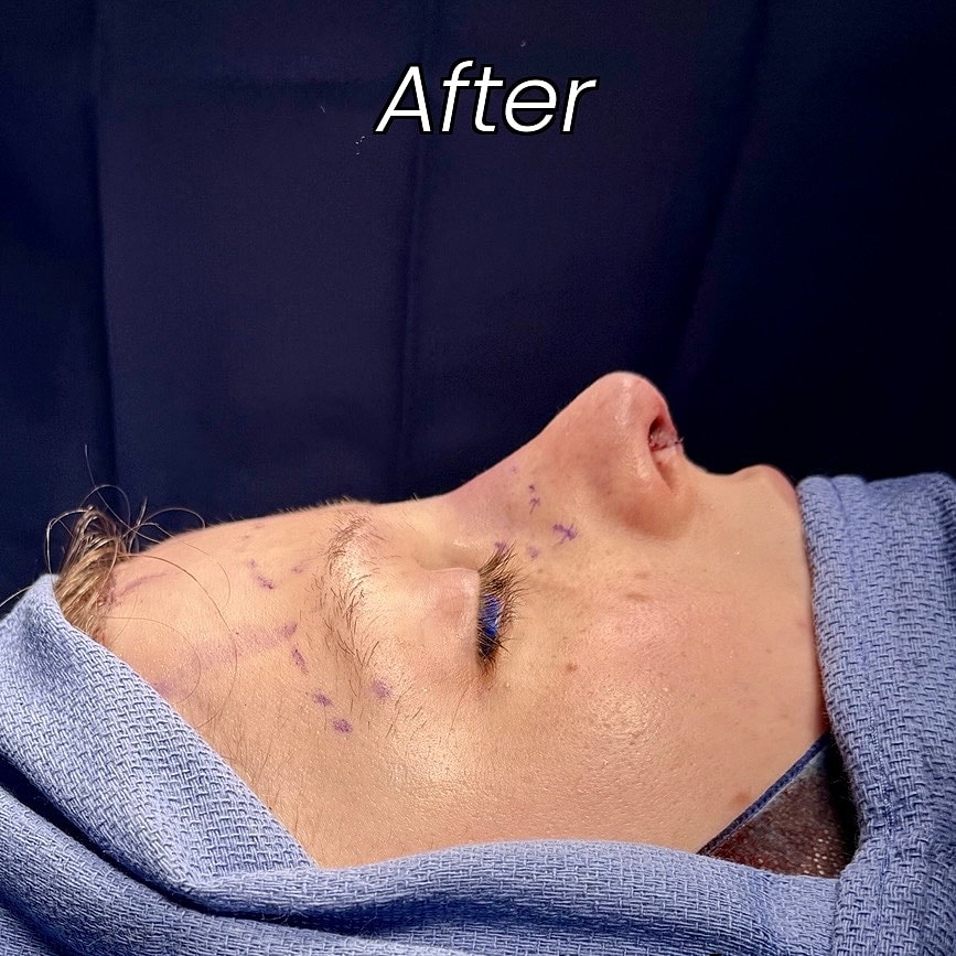 Rhinoplasty Before & After