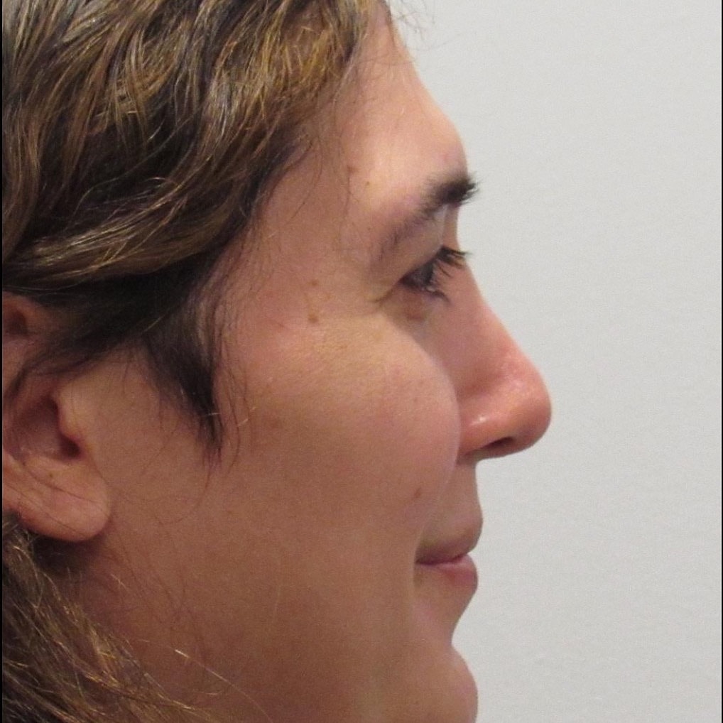 Rhinoplasty Before & After