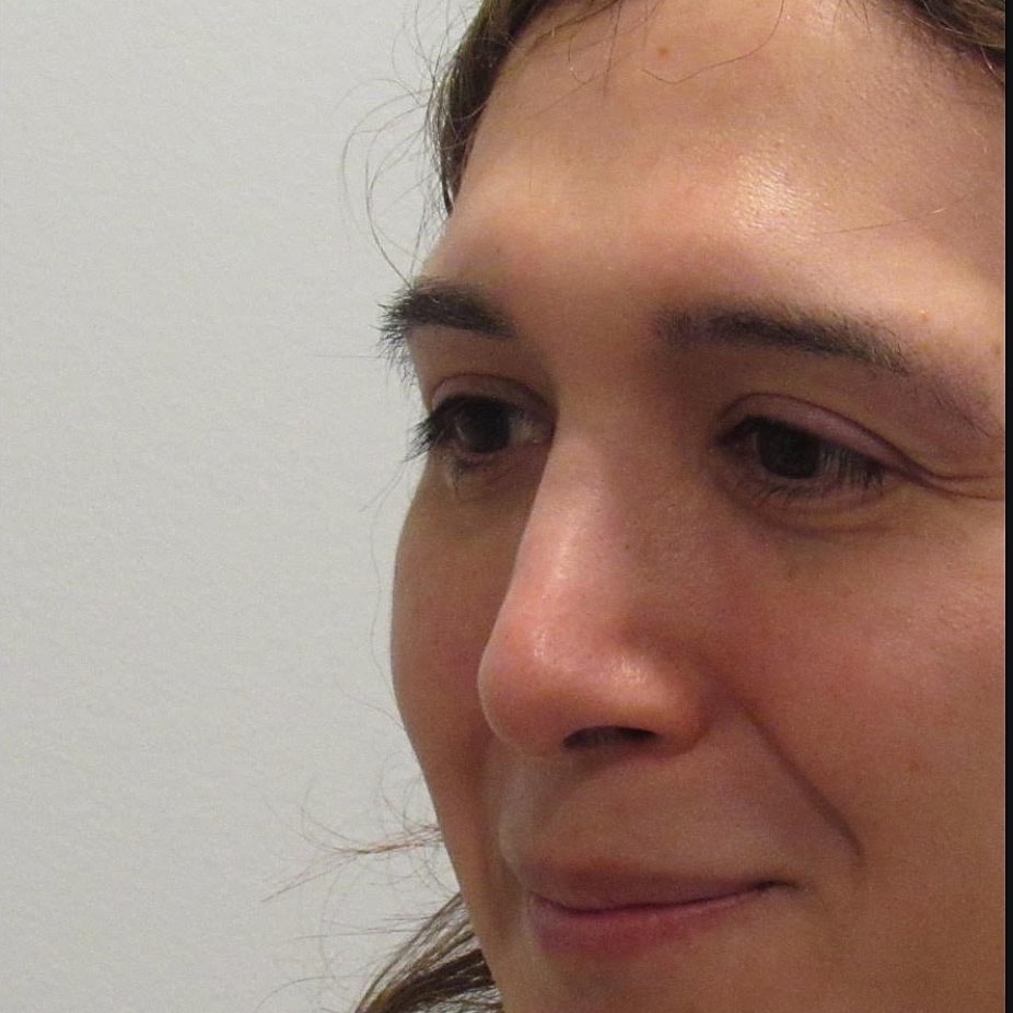 Rhinoplasty Before & After