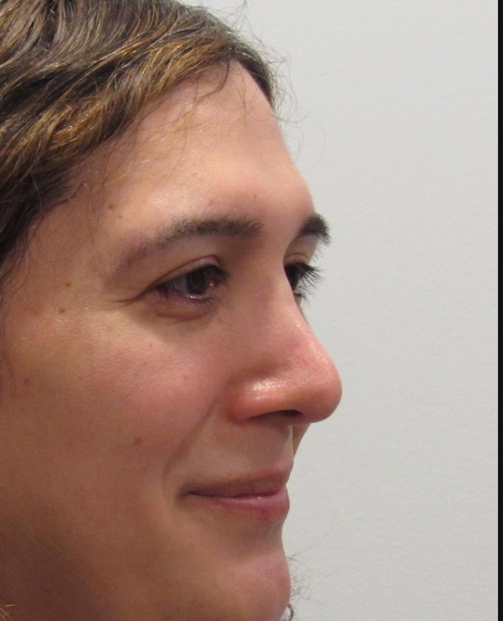 Rhinoplasty Before & After