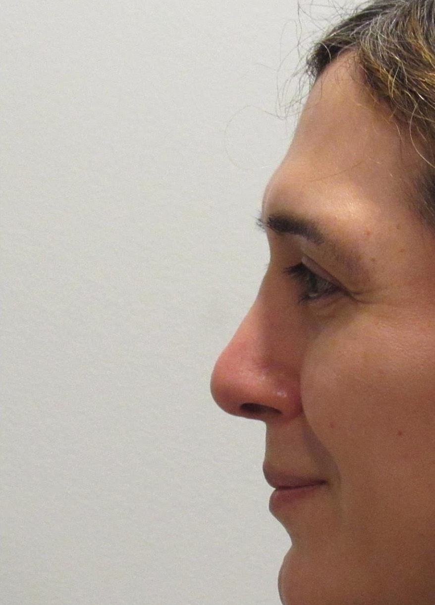 Rhinoplasty Before & After