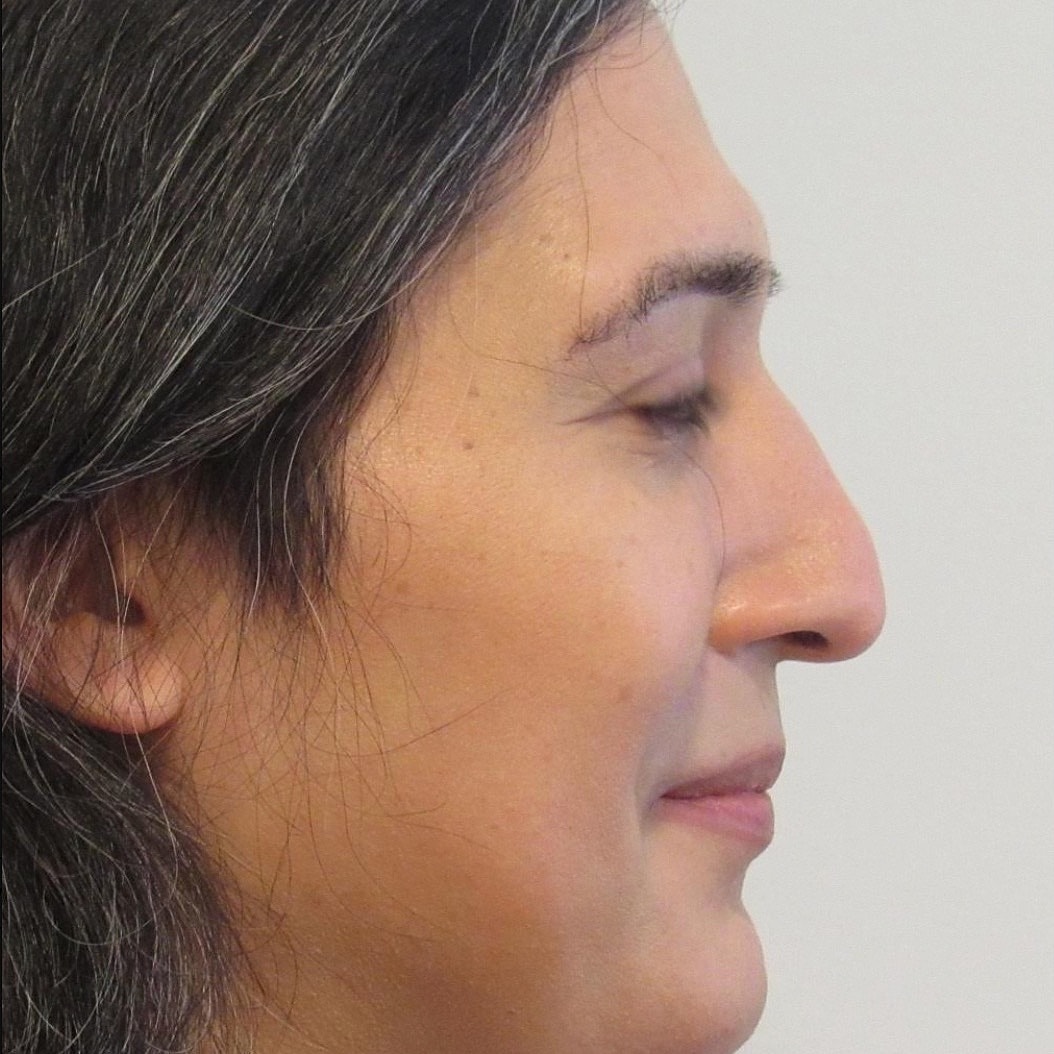 Rhinoplasty Before & After