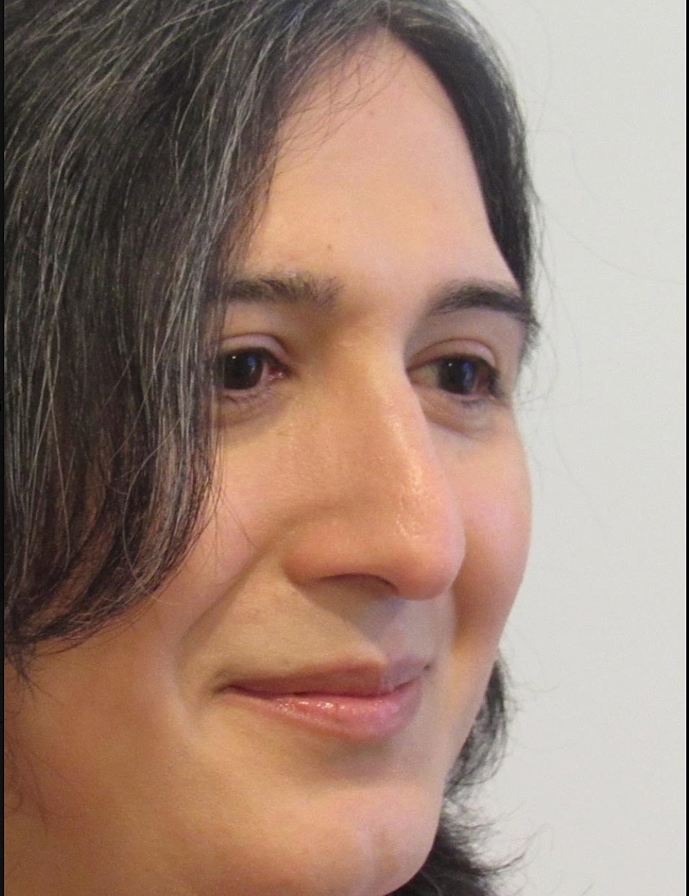 Rhinoplasty Before & After
