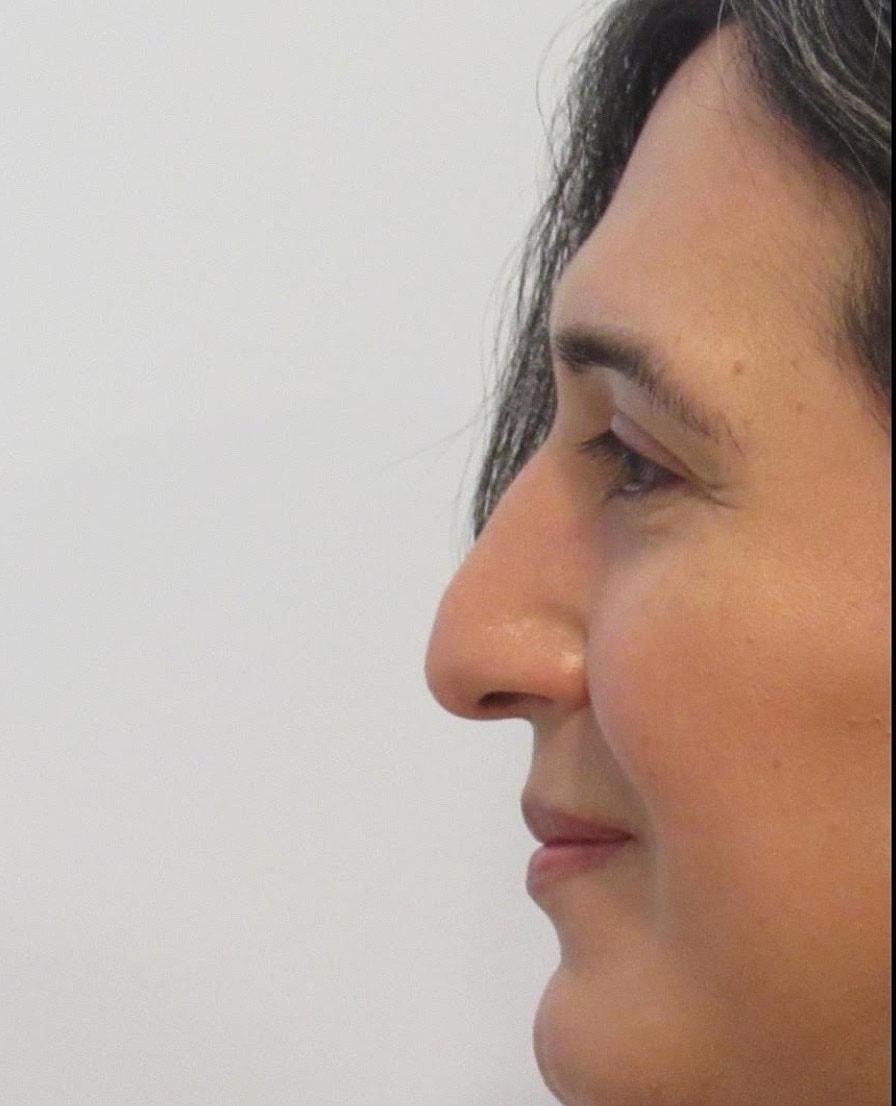 Rhinoplasty Before & After