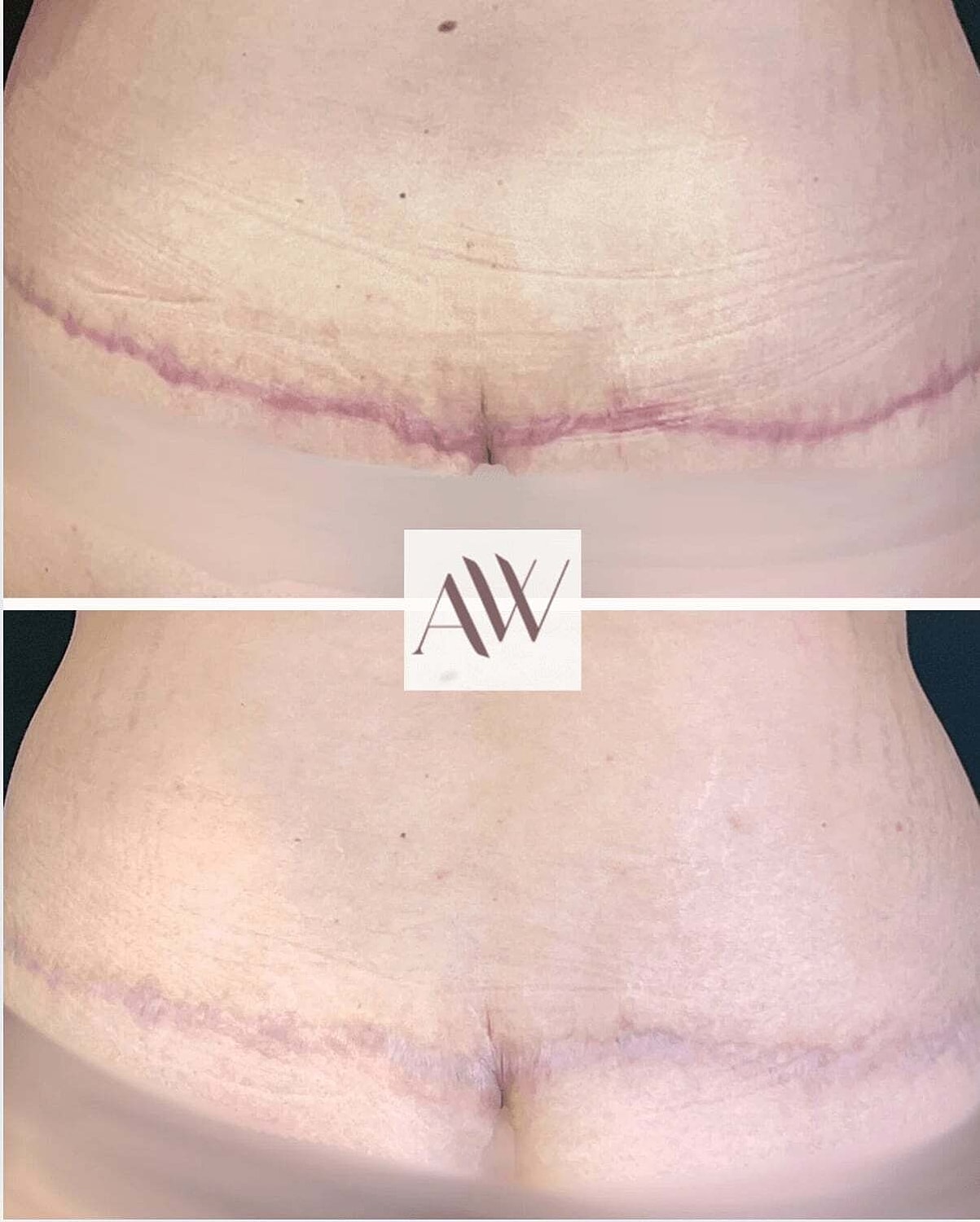 Rf Microneedling Before & After