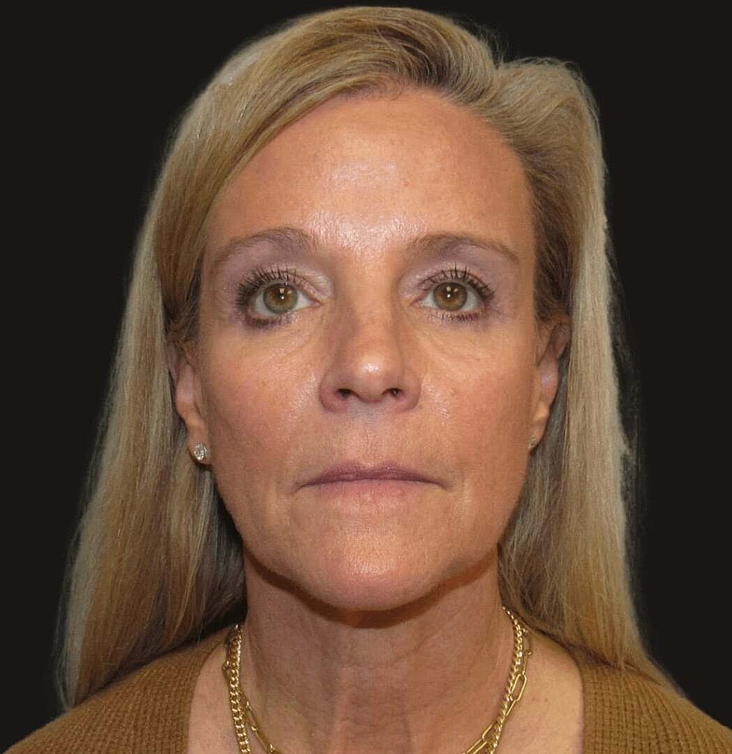 Facelift And Neck Lift Before & After
