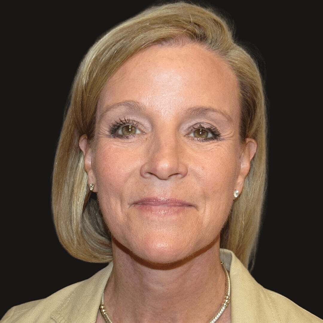 Facelift And Neck Lift Before & After