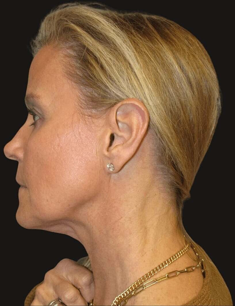 Facelift And Neck Lift Before & After