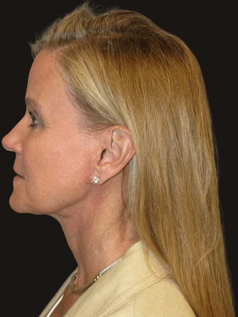 Facelift And Neck Lift Before & After