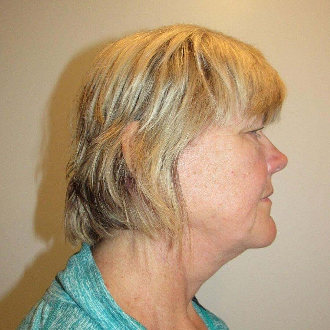 Facelift And Neck Lift Before & After