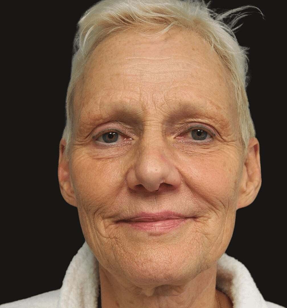 Facelift And Neck Lift Before & After