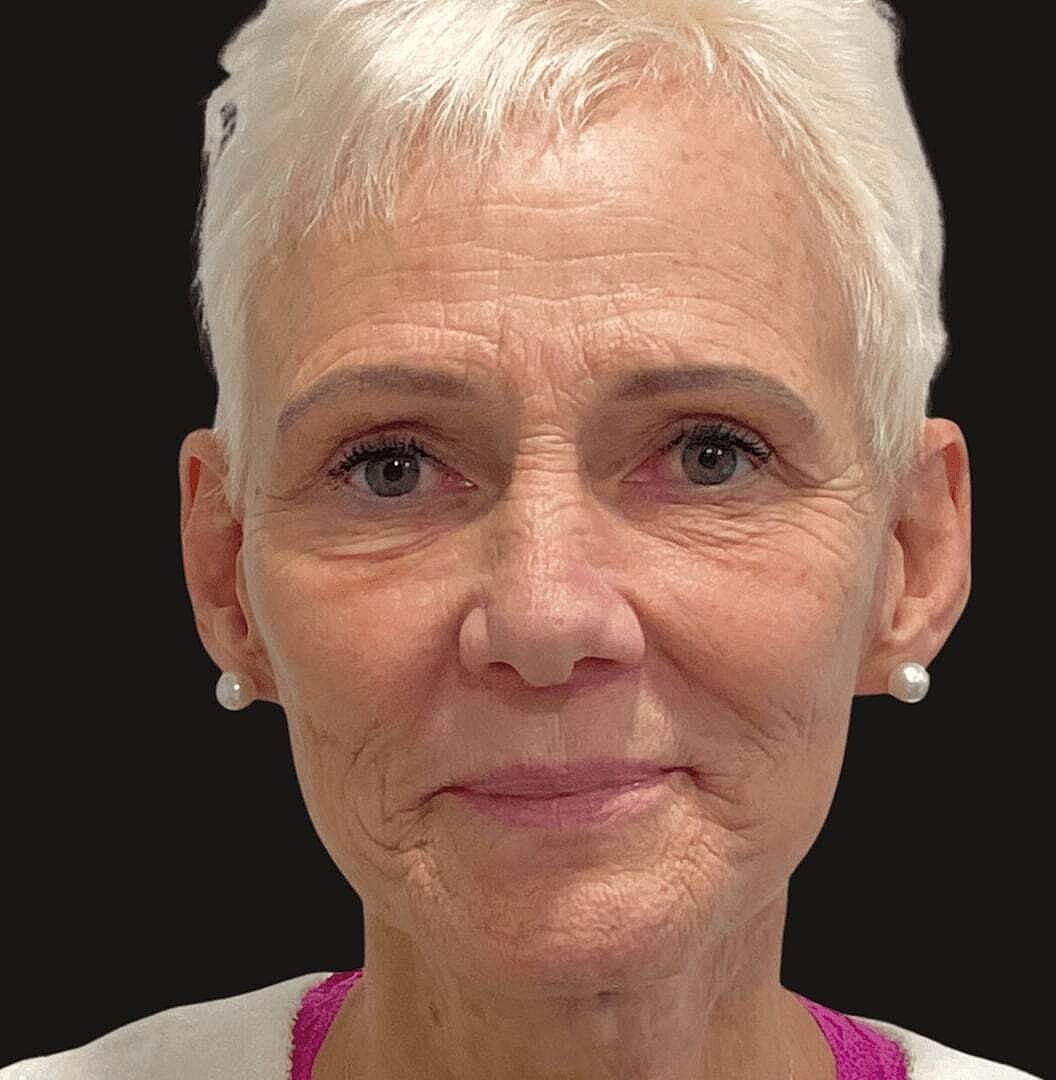 Facelift And Neck Lift Before & After