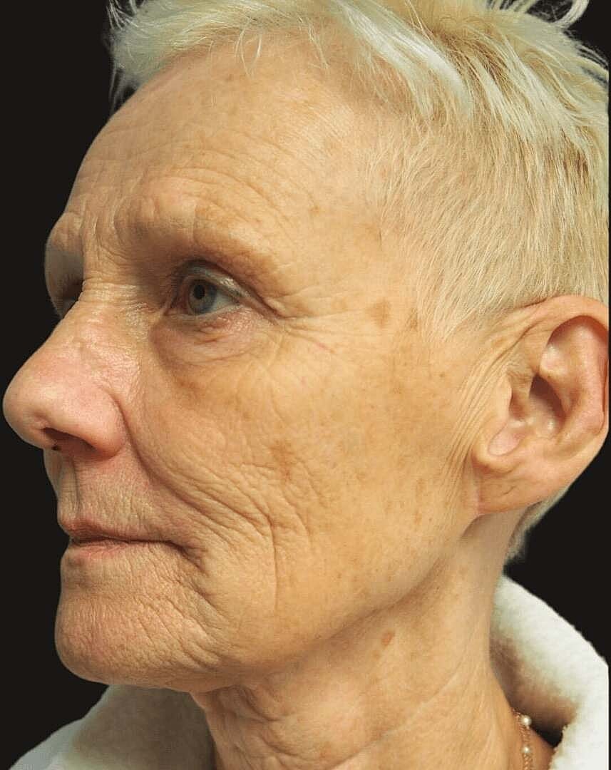 Facelift And Neck Lift Before & After