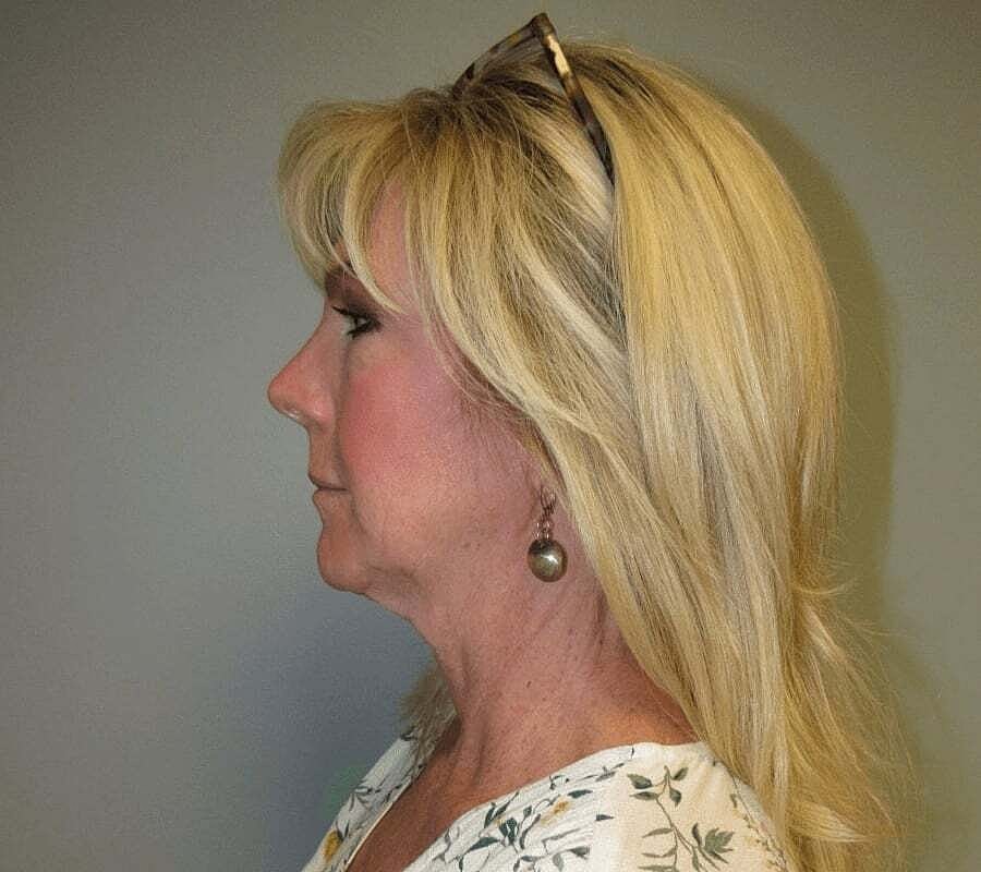 Facelift And Neck Lift Before & After