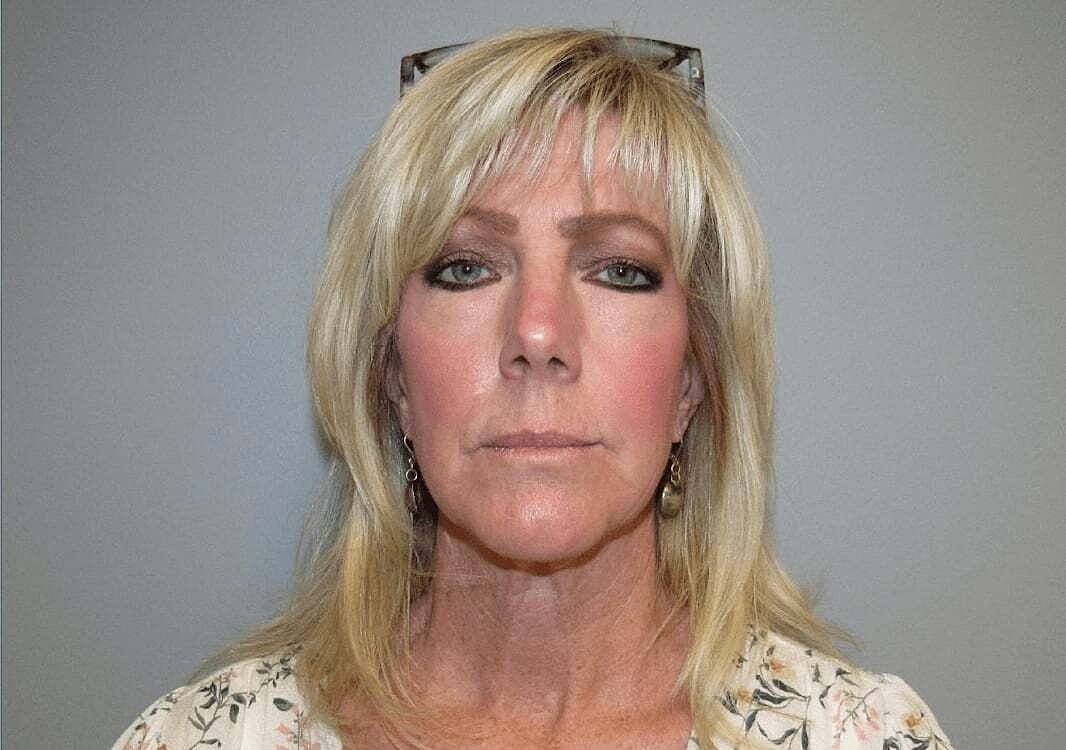 Facelift And Neck Lift Before & After
