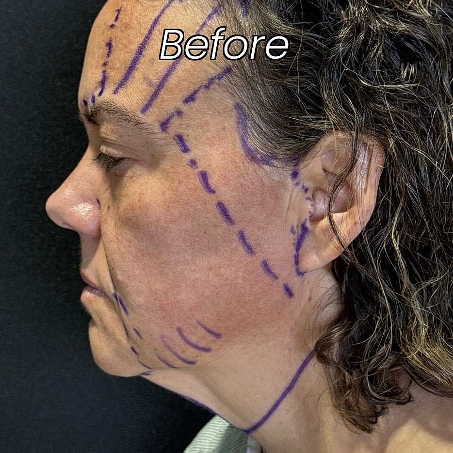 Facelift And Neck Lift Before & After