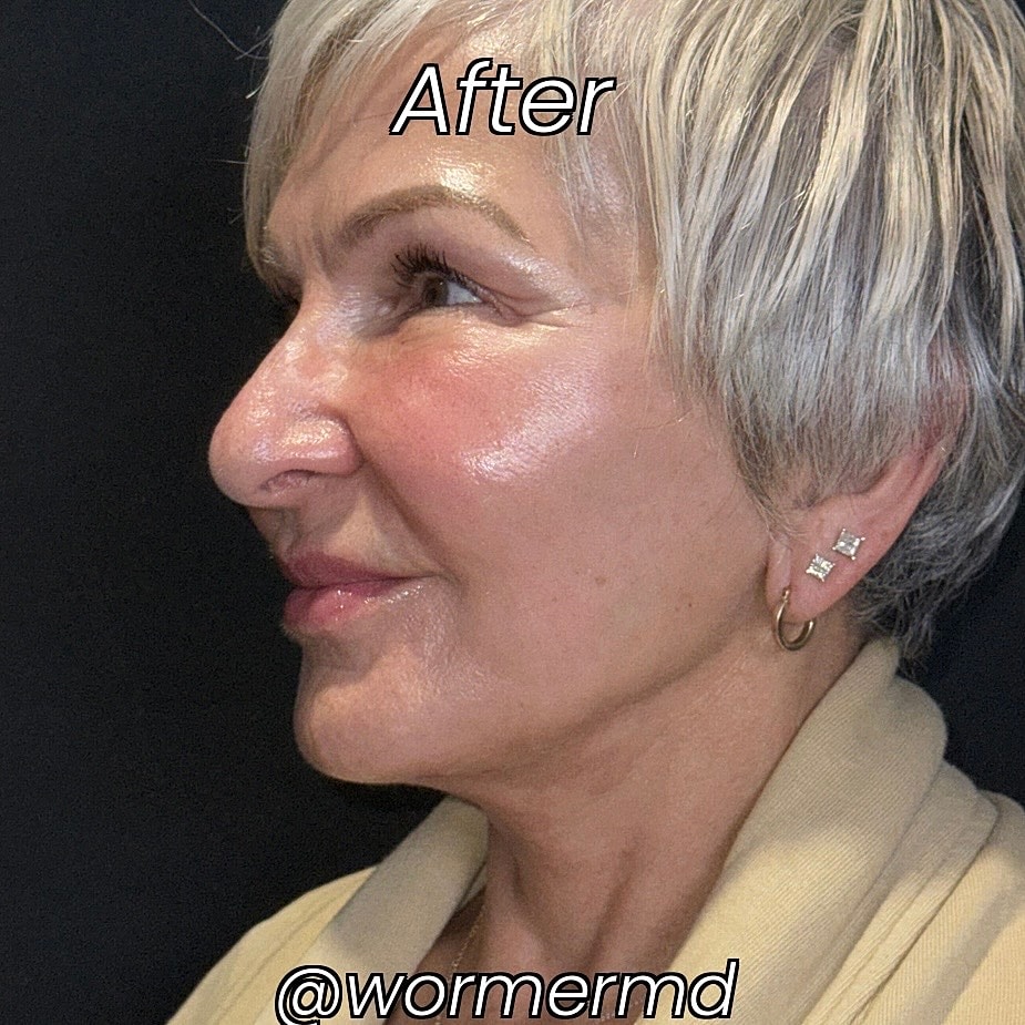 Facelift And Neck Lift Before & After