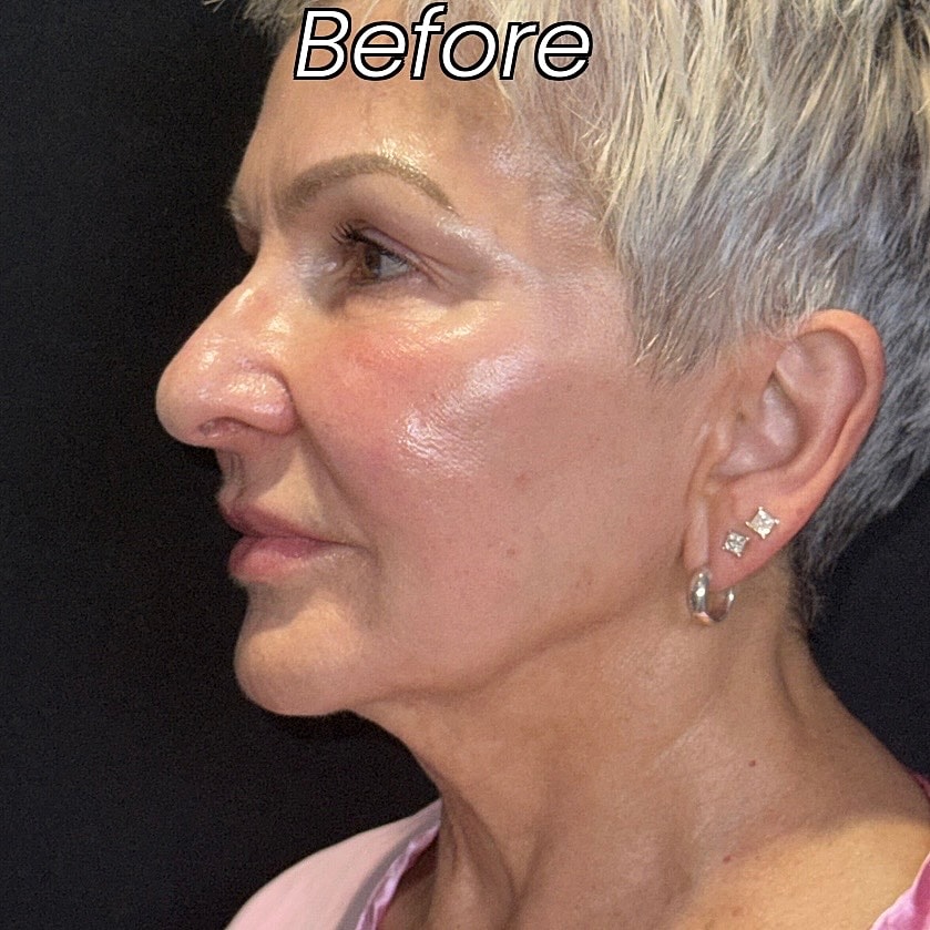 Facelift And Neck Lift Before & After