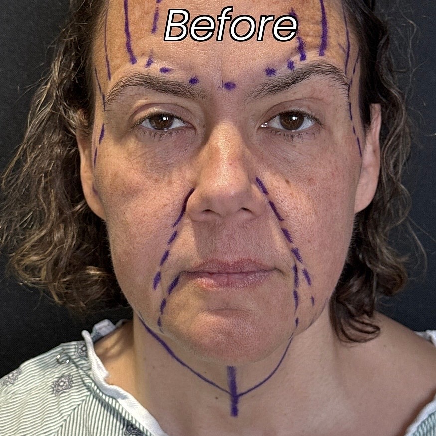 Facelift And Neck Lift Before & After