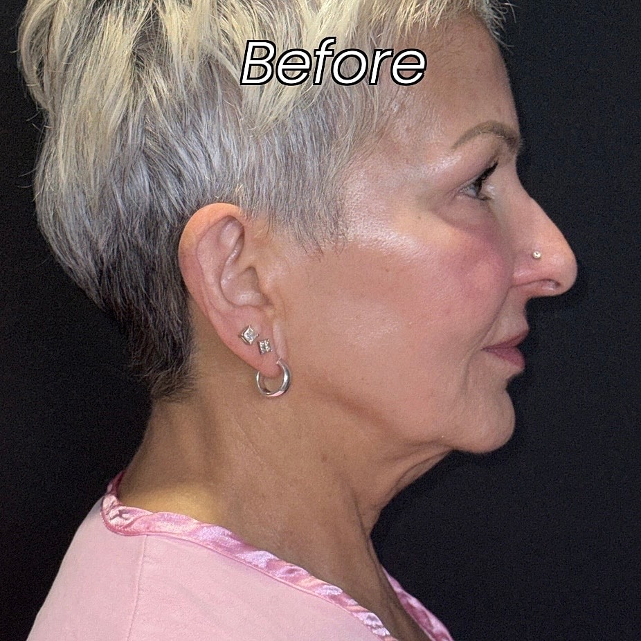 Facelift And Neck Lift Before & After