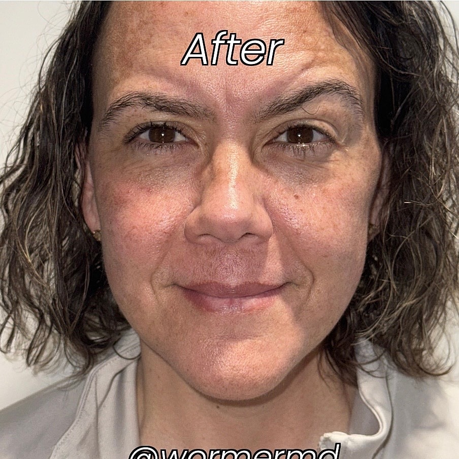 Facelift And Neck Lift Before & After