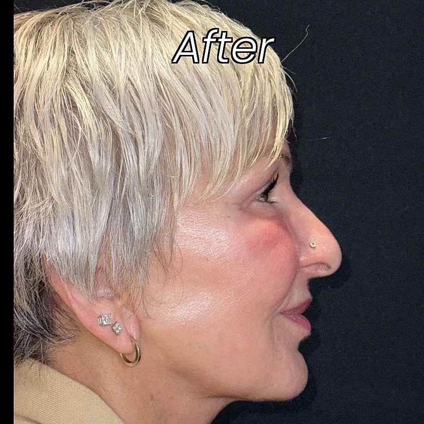 Facelift And Neck Lift Before & After