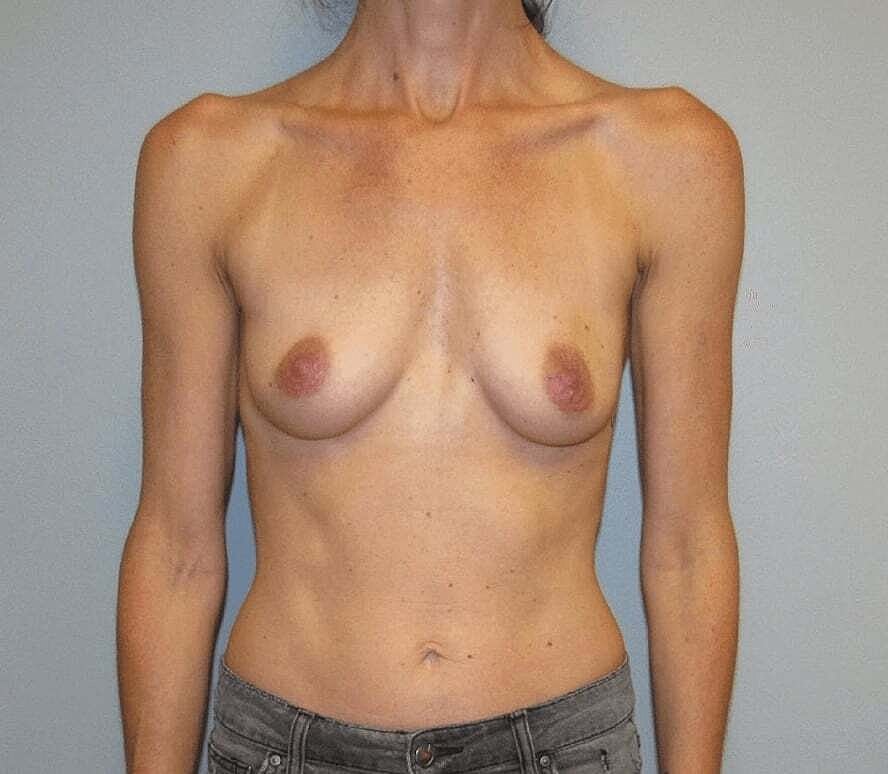 Breast Augmentation Before & After