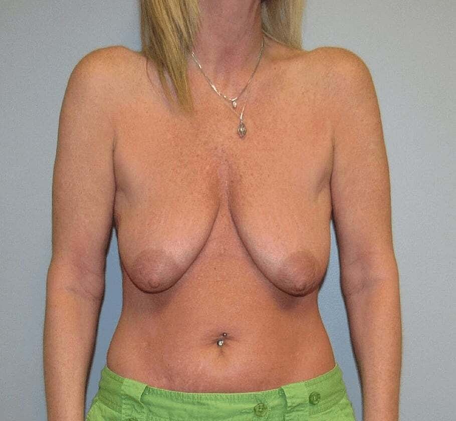 Breast Augmentation Before & After
