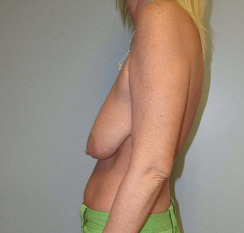 Breast Augmentation Before & After