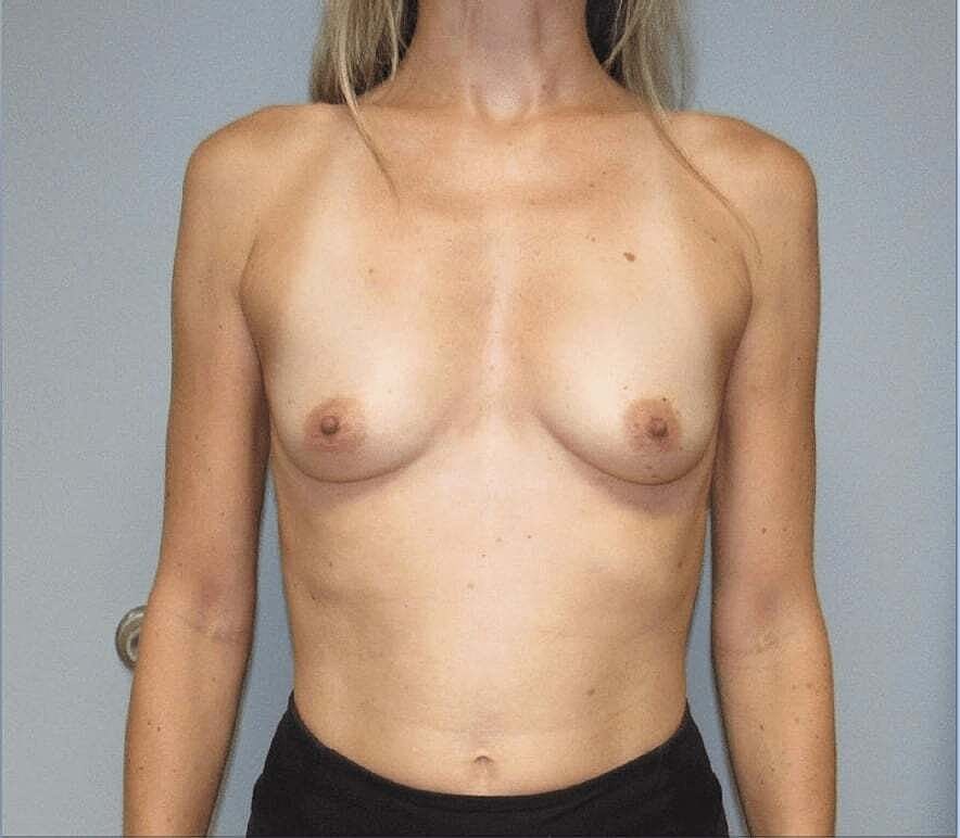 Breast Augmentation Before & After