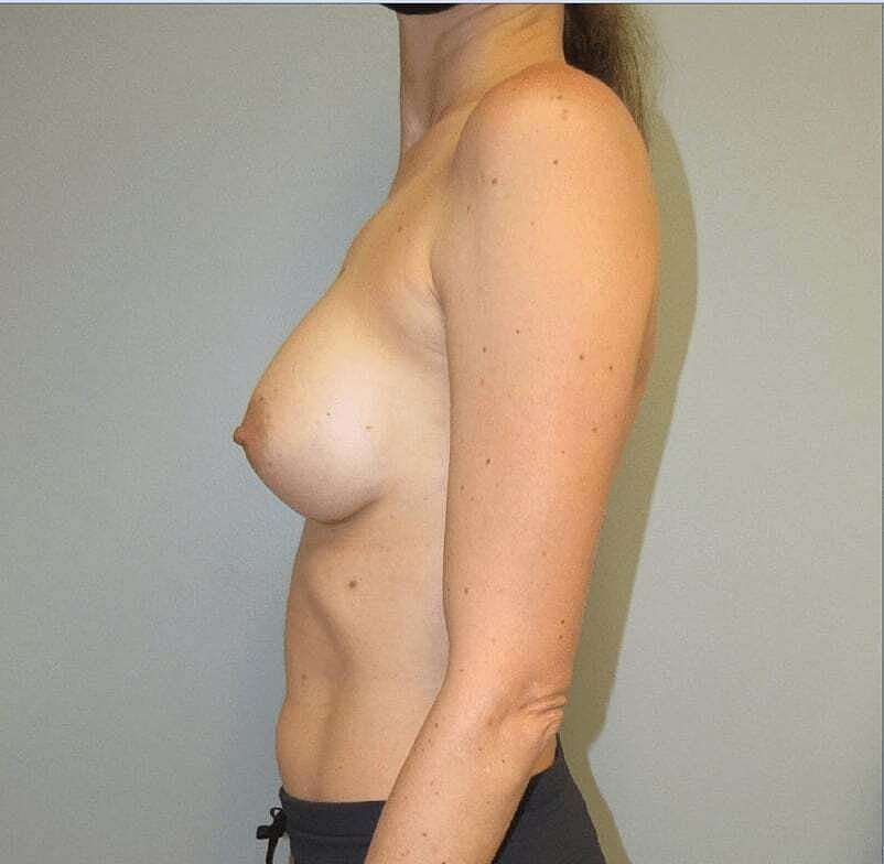 Breast Augmentation Before & After