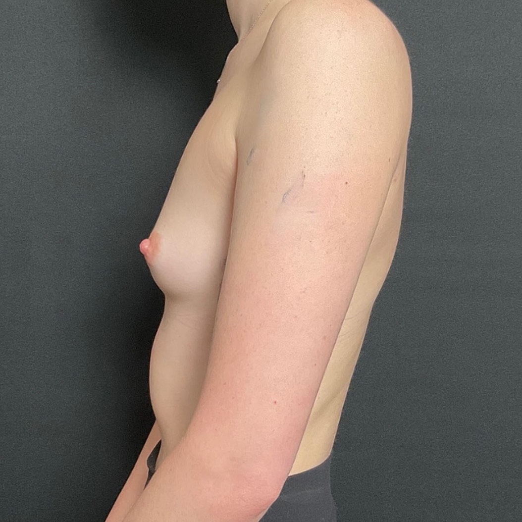 Breast Augmentation Before & After