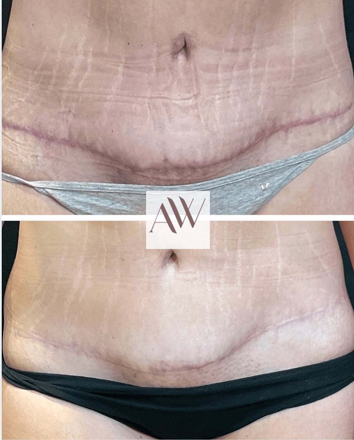 Ipl Before & After