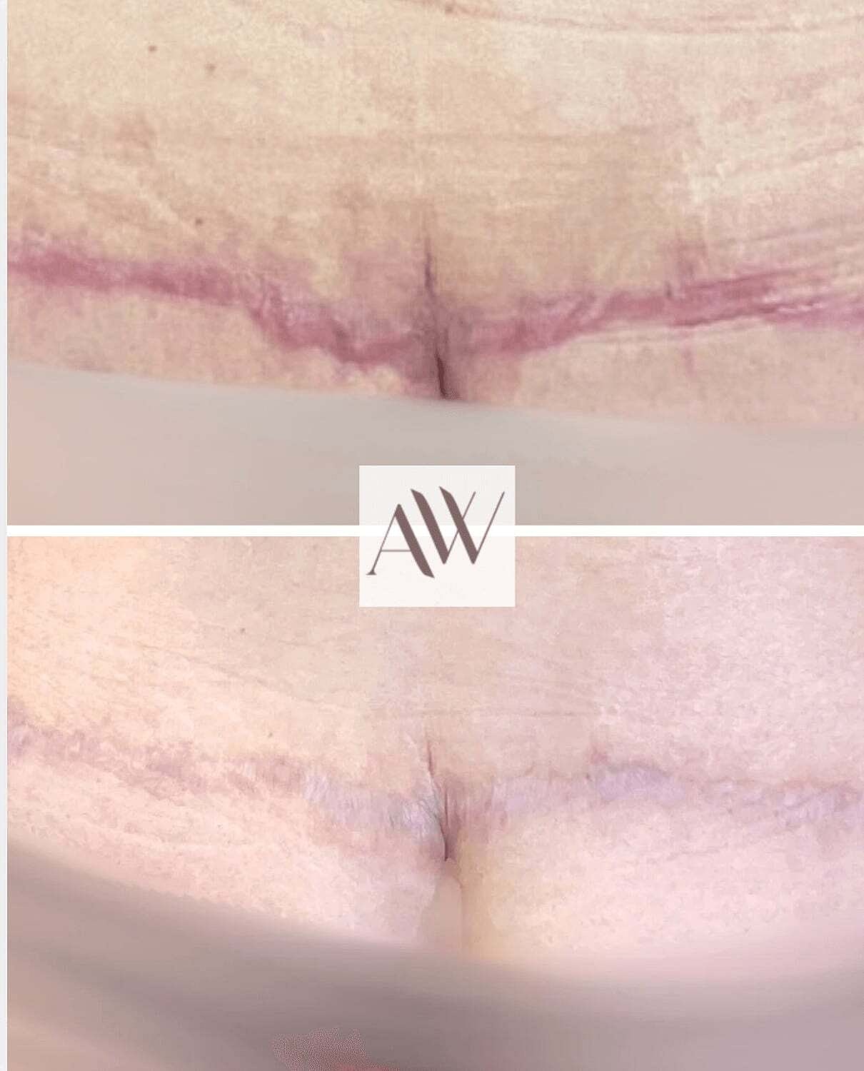 Ipl Before & After