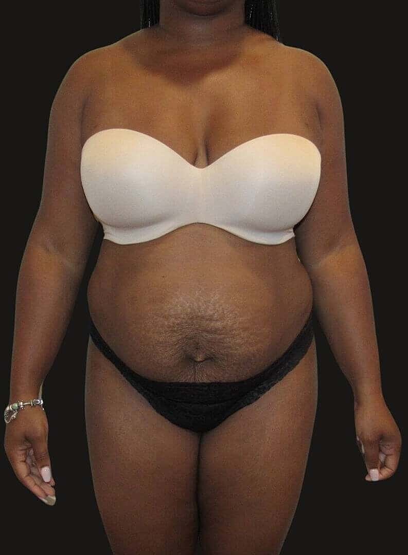 Abdominoplasty Before & After