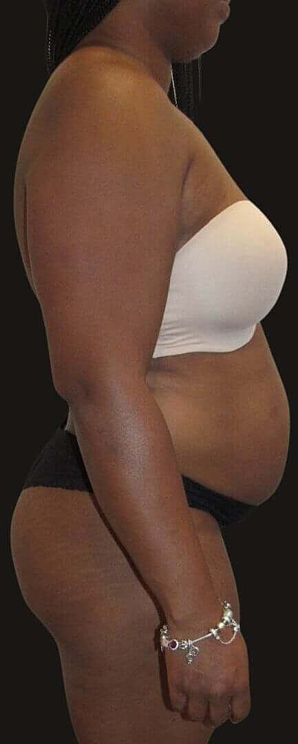 Abdominoplasty Before & After