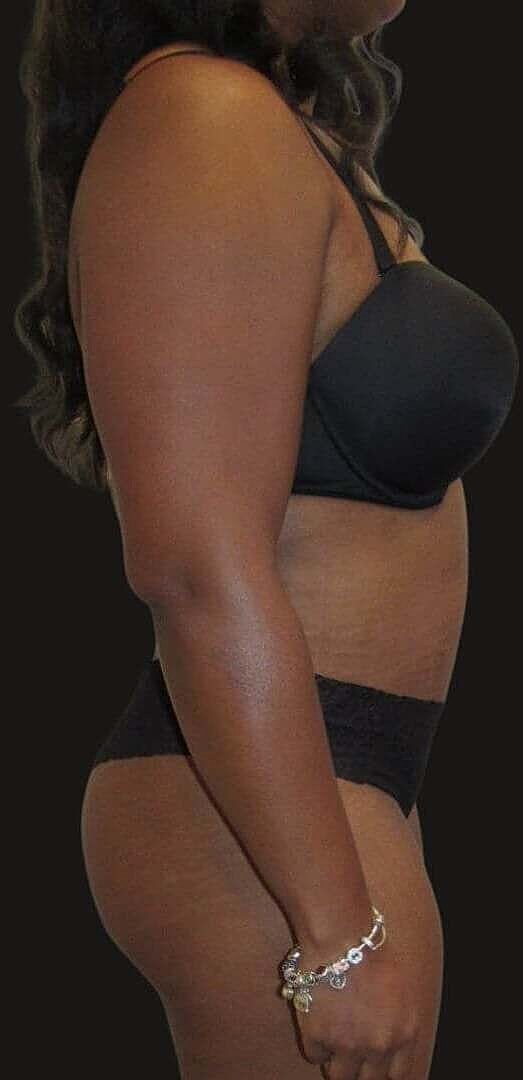 Abdominoplasty Before & After