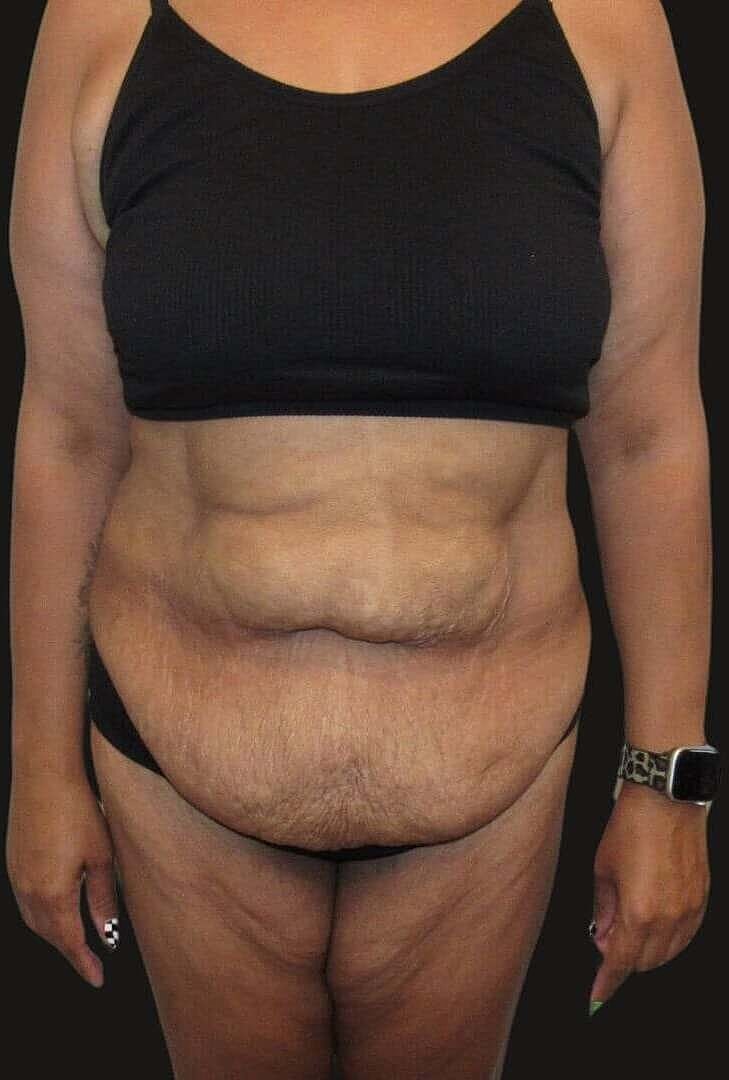 Abdominoplasty Before & After