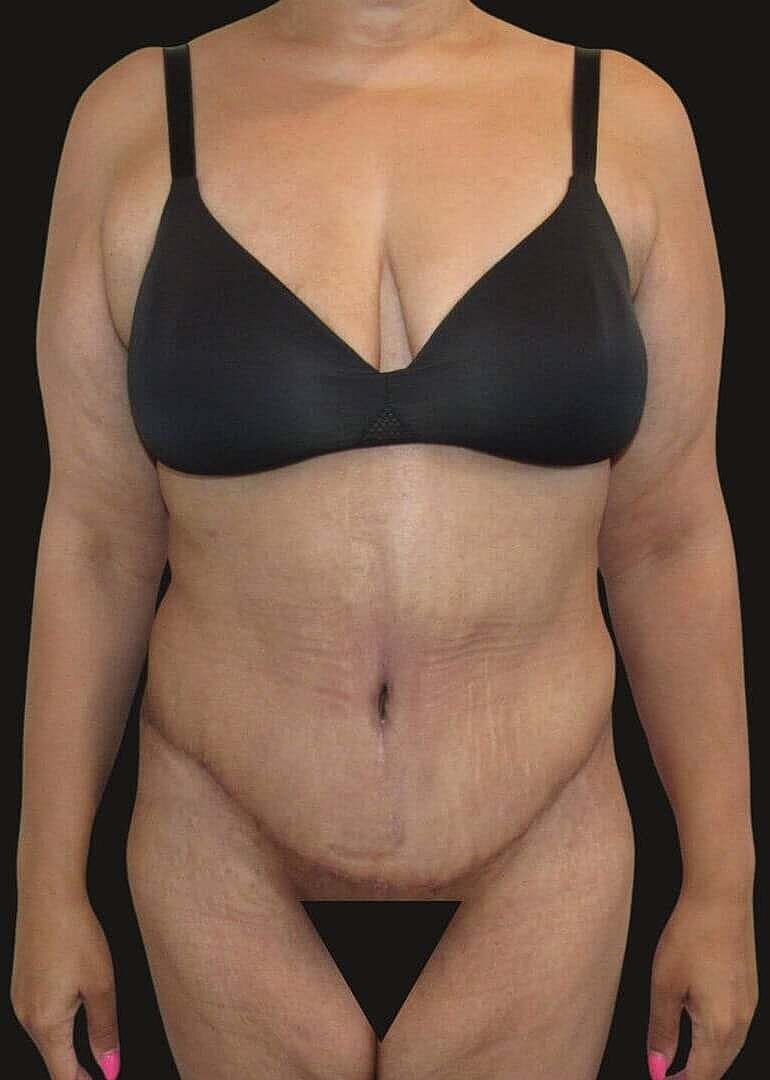 Abdominoplasty Before & After