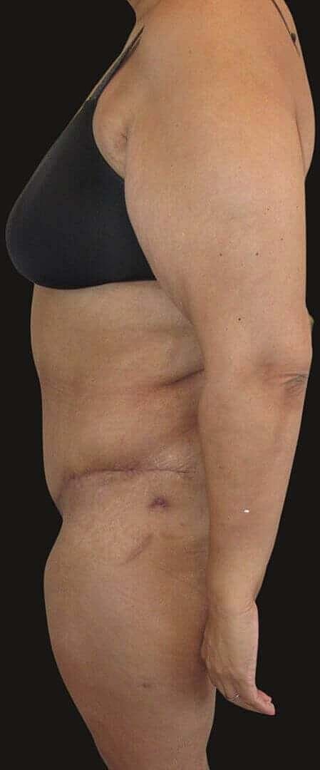 Abdominoplasty Before & After