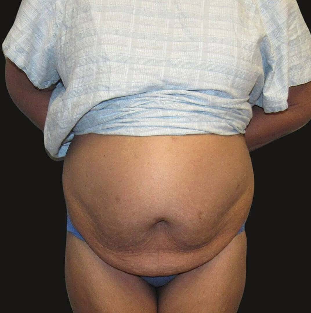 Abdominoplasty Before & After