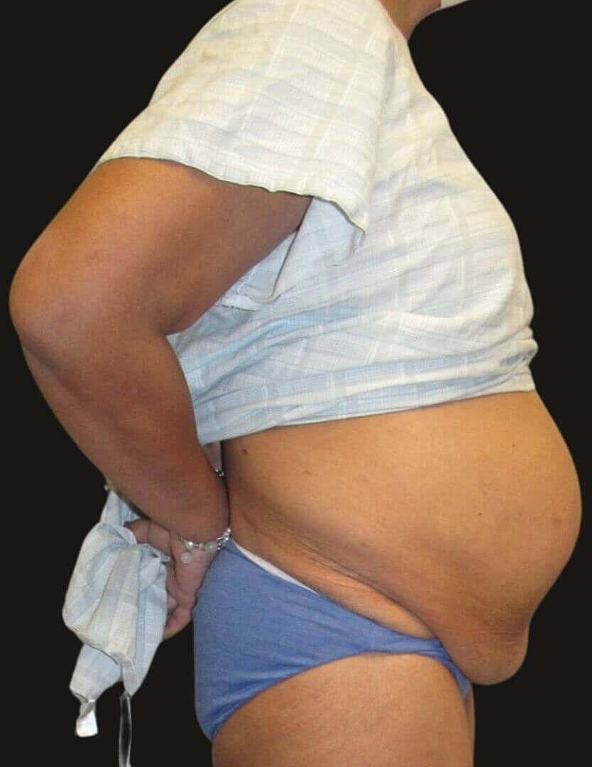 Abdominoplasty Before & After