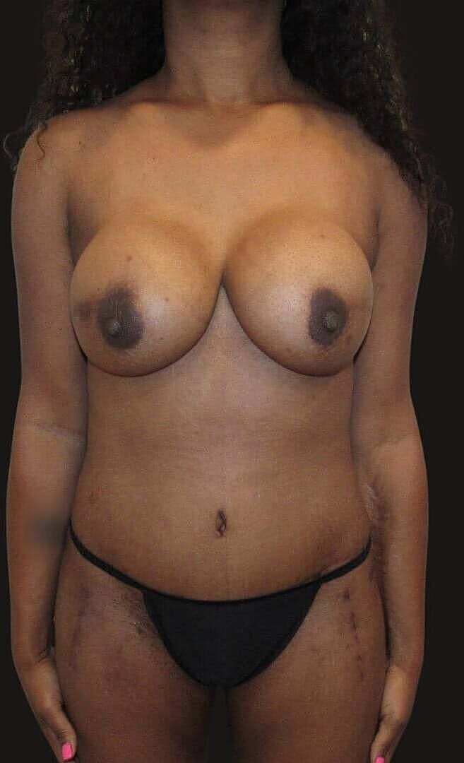 Abdominoplasty Before & After