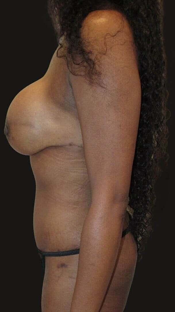 Abdominoplasty Before & After